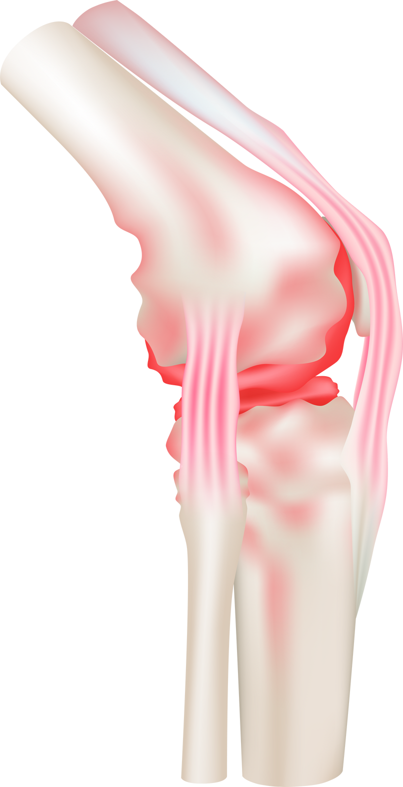 Human bone anatomy Rheumatoid Arthritis (RA) is an inflammatory type of arthritis that usually affects knees. Realistic 3D file PNG